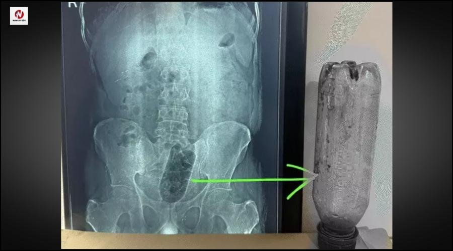 यूपी से आई हैरान करने वाली खबर, सेक्सुअल डिसआर्डर से पीड़ित युवक ने मलाशय में डाली एक लीटर की बोतल, डॉक्टरों ने एक घंटे सर्जरी कर बचाई जान